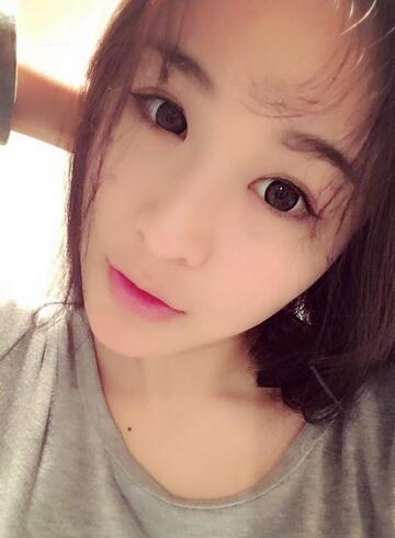 杭州大麦微针龙都整形开眼角+割双眼皮恢复记录