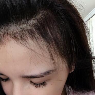 发际线调整果对比图 杭州大麦微针龙都发际线种植