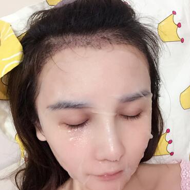 发际线调整果对比图 杭州大麦微针龙都发际线种植