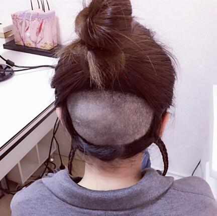 发际线调整果对比图 杭州大麦微针龙都发际线种植