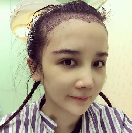 发际线调整果对比图 杭州大麦微针龙都发际线种植