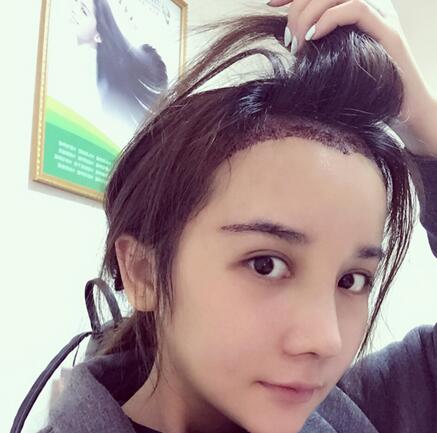 发际线调整果对比图 杭州大麦微针龙都发际线种植