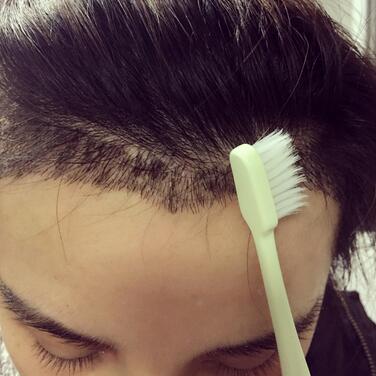 发际线调整果对比图 杭州大麦微针龙都发际线种植