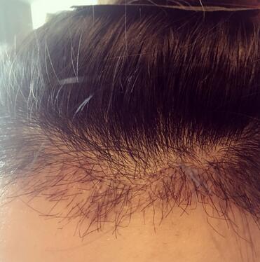 发际线调整果对比图 杭州大麦微针龙都发际线种植