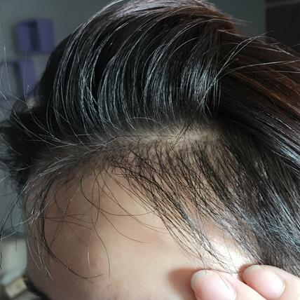 发际线调整果对比图 杭州大麦微针龙都发际线种植