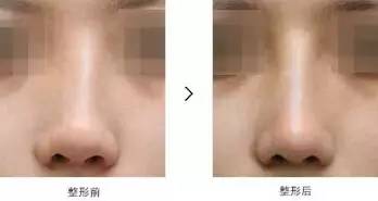 长沙整形医院做隆鼻失败修复多少钱