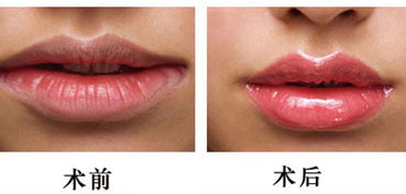 成都做嘴唇整形需要多少钱