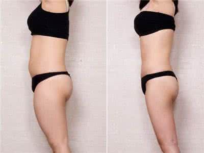 武汉做全身吸脂手术多少钱