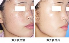 武汉整形医院祛斑大概需要多少钱