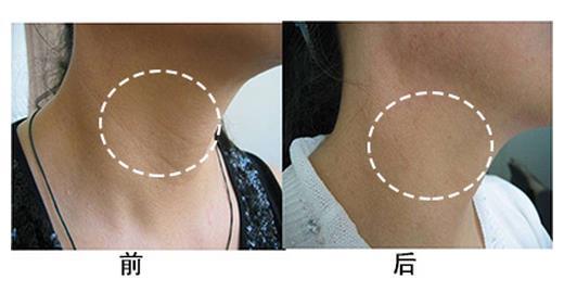 郑州整形医院颈部除皱大概需要多少钱