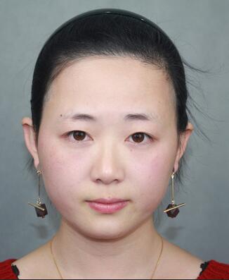 全切双眼皮恢复过程 双眼皮手术前后果对比