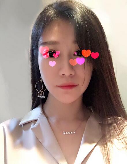 北京叶子磨下颌角整形的果图