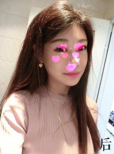 北京叶子磨下颌角整形的果图