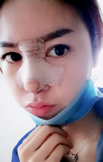 隆鼻整形一个月恢复期图片 武汉壹加壹隆鼻整形案例