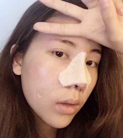 北京艺星王英勇隆鼻案例 隆鼻整形三个月