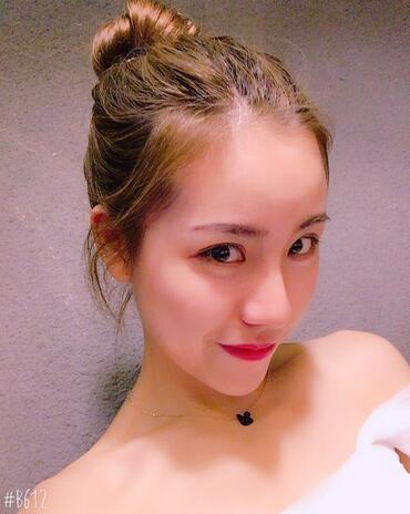 北京艺星王英勇隆鼻案例 隆鼻整形三个月