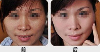 复合彩光祛斑需要多少钱