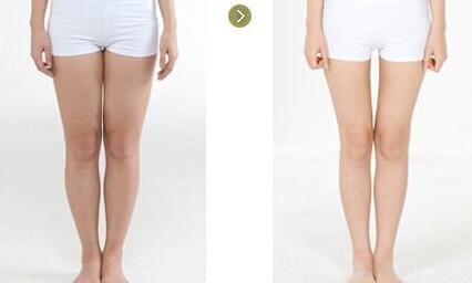 成都整形医院做腿部吸脂的价格是多少