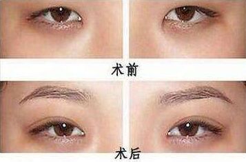 三点定位双眼皮一般多少钱