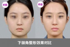 下颌角整形好不好 对比照片