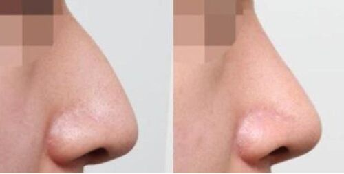 鹰钩鼻整形多少钱 鹰钩鼻矫正术好吗