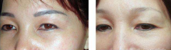 激光洗眉的价格多少钱?洗眉后要注意什么? 激光洗眉的价格多少钱?洗眉后要注意什么?