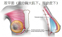 什么是双平面隆胸？双平面隆胸有哪些优势？