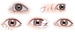 开眼角手术过程是怎样的 开眼角手术过程图