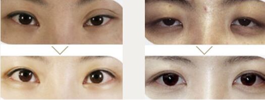 韩式微创开眼角多少钱 韩式微创开眼角好吗