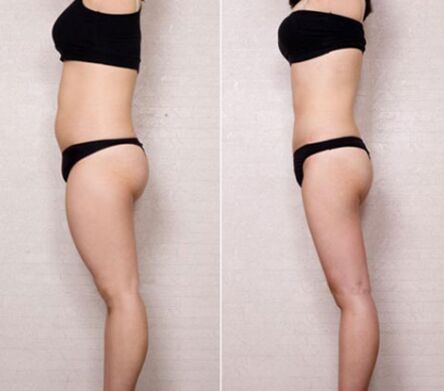 全身吸脂减肥价格 做个全身吸脂多少钱