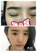 埋线双眼皮几天消肿?手术恢复果对比图 埋线双眼皮几天消肿?手术恢复果对比图