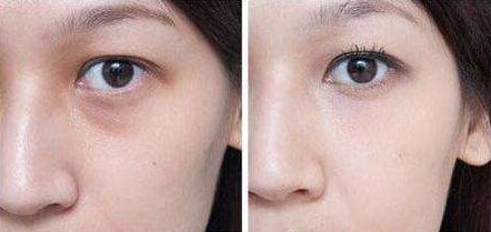 抬头纹怎么去 去除抬头纹要多少钱