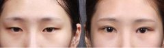 开眼角手术后多久能恢复