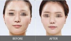 面部吸脂是永.久性的吗 面部吸脂果图