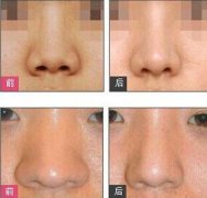 鼻翼缩小前后对比照片_变美如此简单