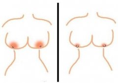 乳头乳晕漂红会对以后哺乳有影响吗 乳头乳晕漂红会对以后哺乳有影响吗