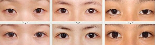 做双眼皮手术的方法一般有几种
