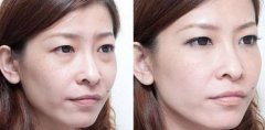 全新Z齐全韩式微创去眼袋的过程、价格、副作用、维持时间 全新Z齐全韩式微创去眼袋的过程、价格、副作用、维持时间