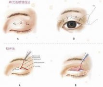 埋线双眼皮的手术时间长吗？术后怎么护理？