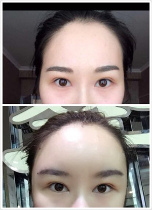 自体脂肪丰太阳穴 丰额头案例以及前后对比照片分享