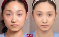 上海做电波l皮果维持时间多长?费用是多少?