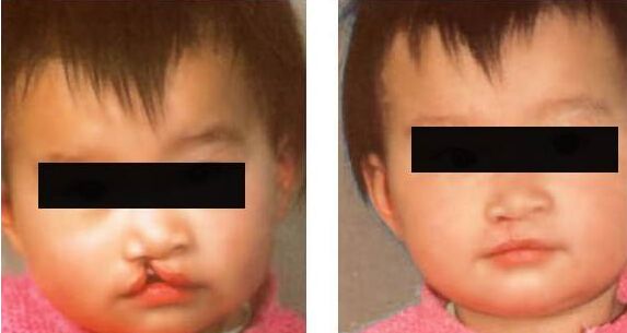 兔唇整形需要多少钱 唇腭裂整形修复图片