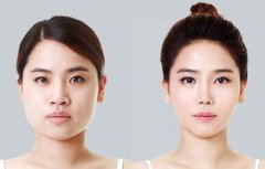 圆脸怎么变成瓜子脸 快速有的瘦脸方法