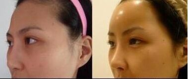 额头太扁了怎么办，如何解决额头扁平