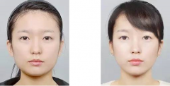 B****多少钱一针,打B****案例,前后果对比图