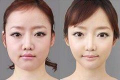 一位美女网友的自述削骨手术过程
