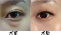 如何有的去除眼部眼袋? 如何有的去除眼部眼袋?