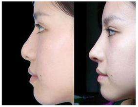 假体隆鼻术后果自然吗，看着假不假