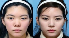 硅胶假体隆鼻一般可以保持多久