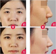 硅胶隆鼻果怎么样 硅胶假体隆鼻对比图